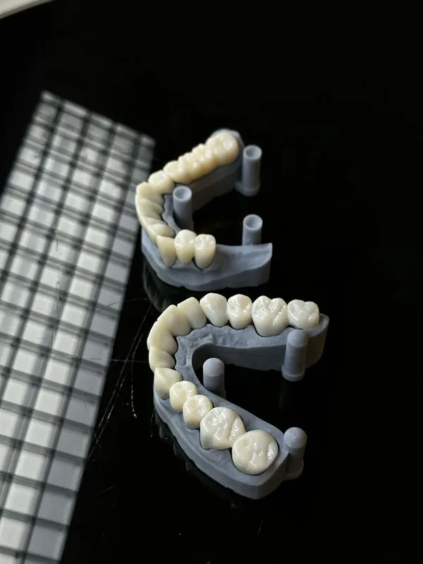 Zirconia dental crown fabrication in a dental laboratory — the premium crown material available at Turkish and UK dental clinics from £500